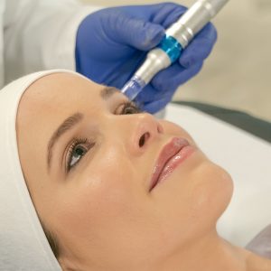 Formation-microneedling